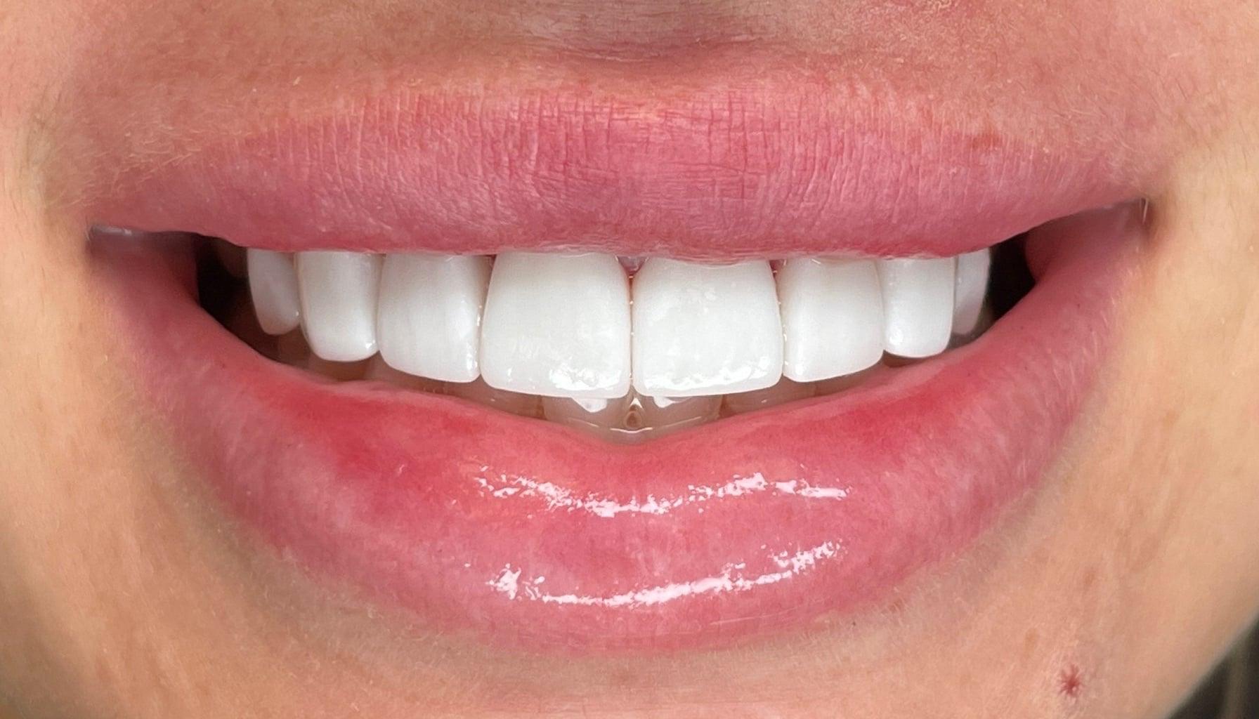 Cool Springs Family Dentistry, PLLC smile makeover after — Franklin, TN