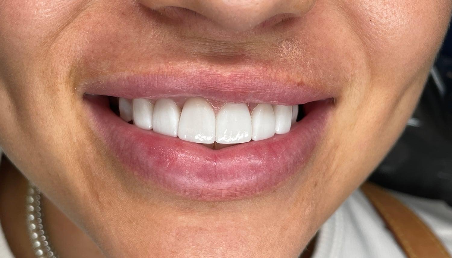 Cool Springs Family Dentistry, PLLC smile makeover after — Franklin, TN