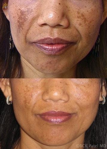 Patel Plastic Surgery photofacial result — Salt Lake City, UT