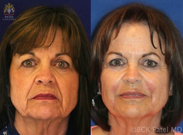 Patel Plastic Surgery botox result — Salt Lake City, UT