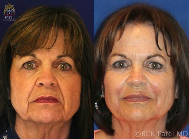 Botox result at Patel Plastic Surgery in Salt Lake City, UT