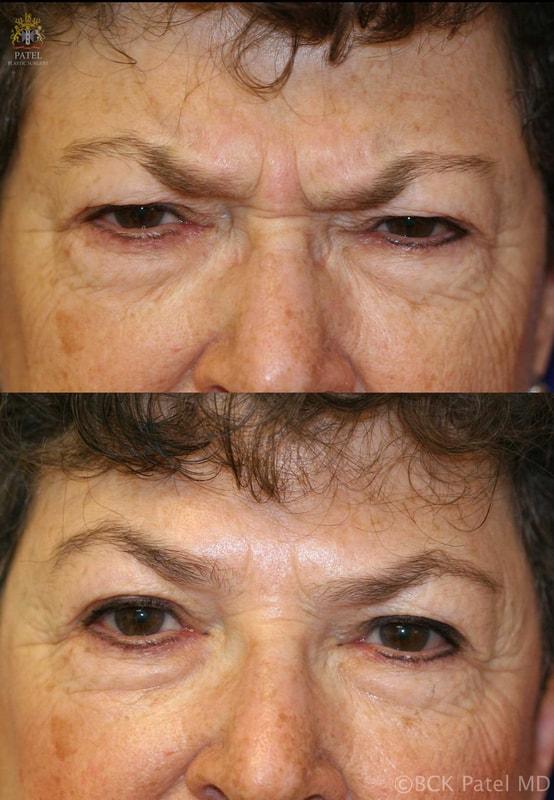 Patel Plastic Surgery botox result — Salt Lake City, UT