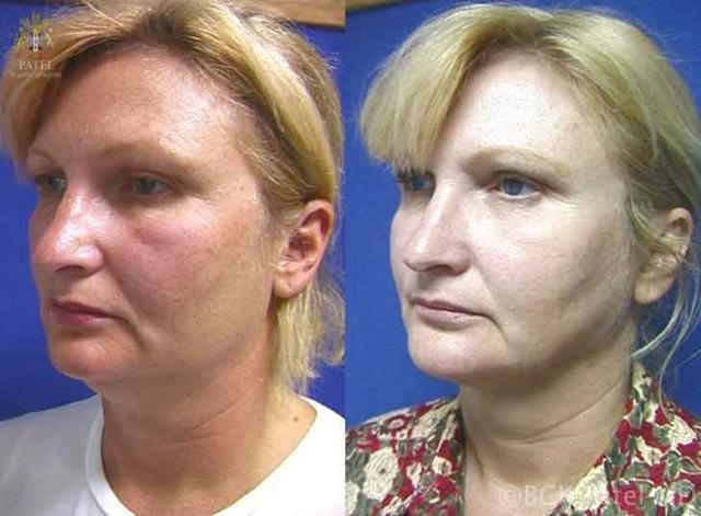 Neck Liposuction result at Patel Plastic Surgery in Salt Lake City, UT