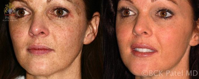 Patel Plastic Surgery photofacial result — Salt Lake City, UT