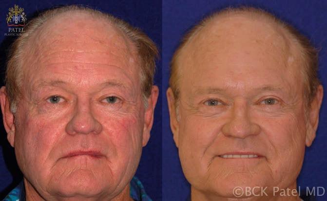 Patel Plastic Surgery photofacial result — Salt Lake City, UT