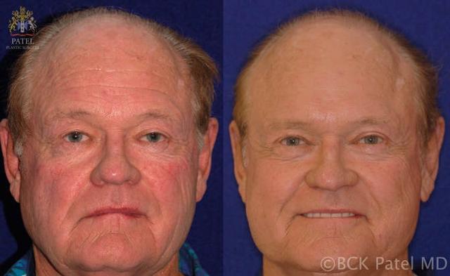 Morpheus8 result at Patel Plastic Surgery in Salt Lake City, UT