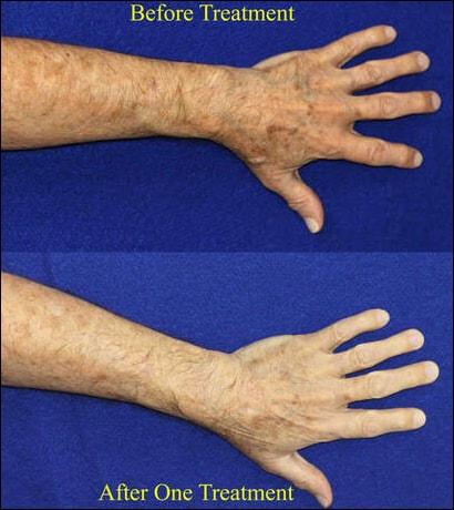 Patel Plastic Surgery photofacial result — Salt Lake City, UT