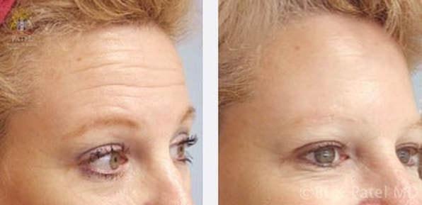 Patel Plastic Surgery botox result — Salt Lake City, UT