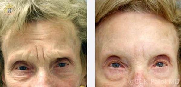 Patel Plastic Surgery botox result — Salt Lake City, UT