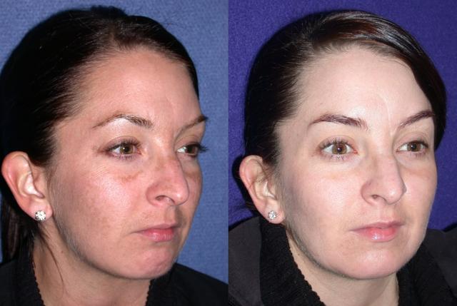 Chemical Peel result at Patel Plastic Surgery in Salt Lake City, UT