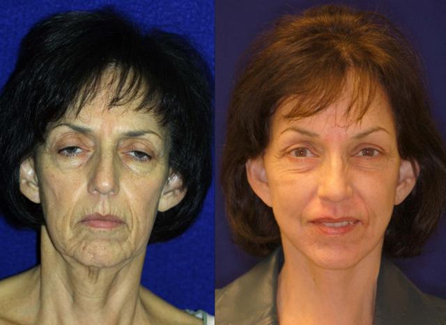 Brow Lift result at Patel Plastic Surgery in Salt Lake City, UT