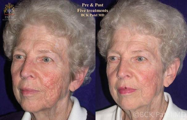 Patel Plastic Surgery photofacial result — Salt Lake City, UT
