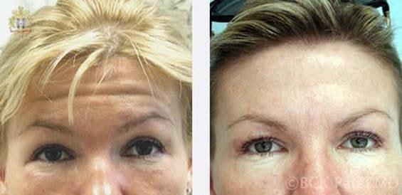 Patel Plastic Surgery botox result — Salt Lake City, UT