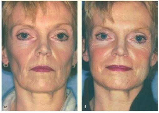 Fat Transfer result at Patel Plastic Surgery in Salt Lake City, UT