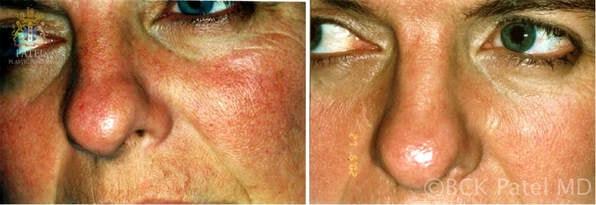 Patel Plastic Surgery photofacial result — Salt Lake City, UT