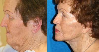 Neck Lift result at Patel Plastic Surgery in Salt Lake City, UT
