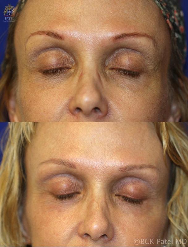 Laser Skin Resurfacing result at Patel Plastic Surgery in Salt Lake City, UT