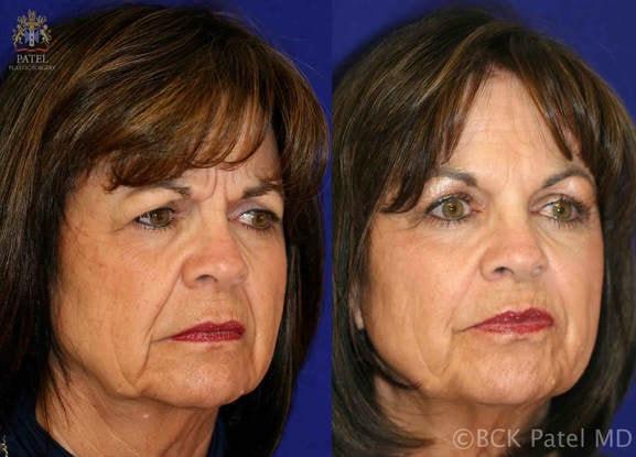 Juvederm result at Patel Plastic Surgery in Salt Lake City, UT