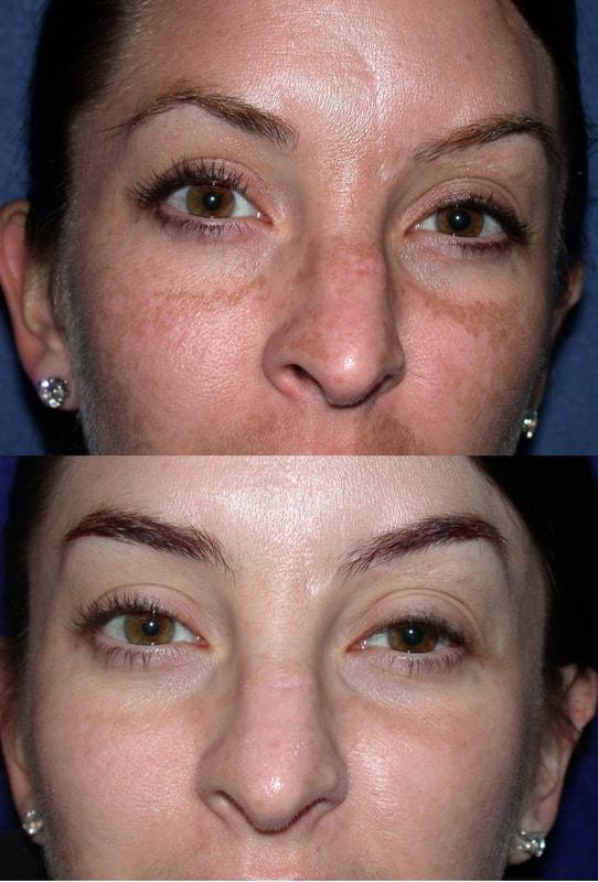Chemical Peel result at Patel Plastic Surgery in Salt Lake City, UT
