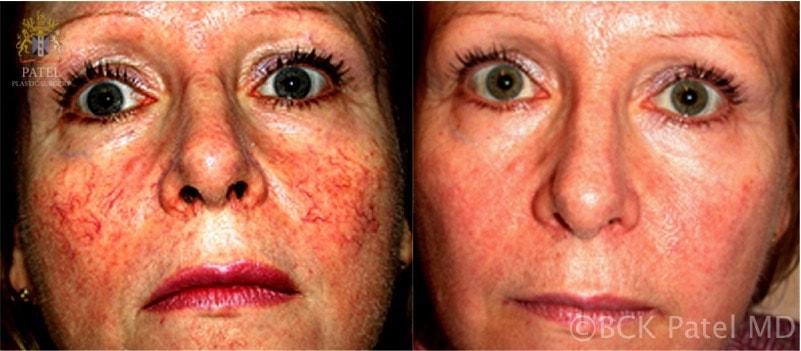 Patel Plastic Surgery photofacial result — Salt Lake City, UT