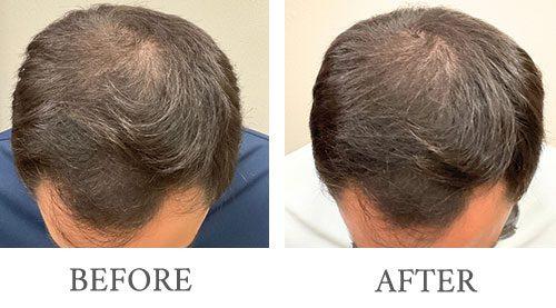 Bopp Dermatology & Facial Plastic Surgery hair restoration result — Metairie, LA