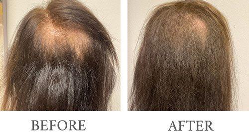 Bopp Dermatology & Facial Plastic Surgery hair restoration result — Metairie, LA