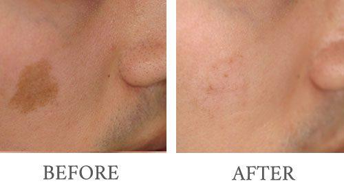 Laser Skin Resurfacing result at Bopp Dermatology & Facial Plastic Surgery in Metairie, LA