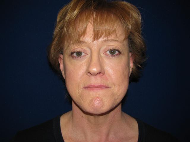 Facelift after at LV Plastic Surgery (Brian J. Parker, MD) in Las Vegas, NV