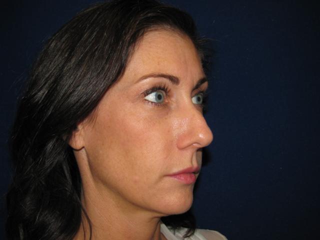Rhinoplasty before at LV Plastic Surgery (Brian J. Parker, MD) in Las Vegas, NV
