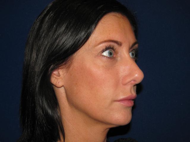 Rhinoplasty after at LV Plastic Surgery (Brian J. Parker, MD) in Las Vegas, NV