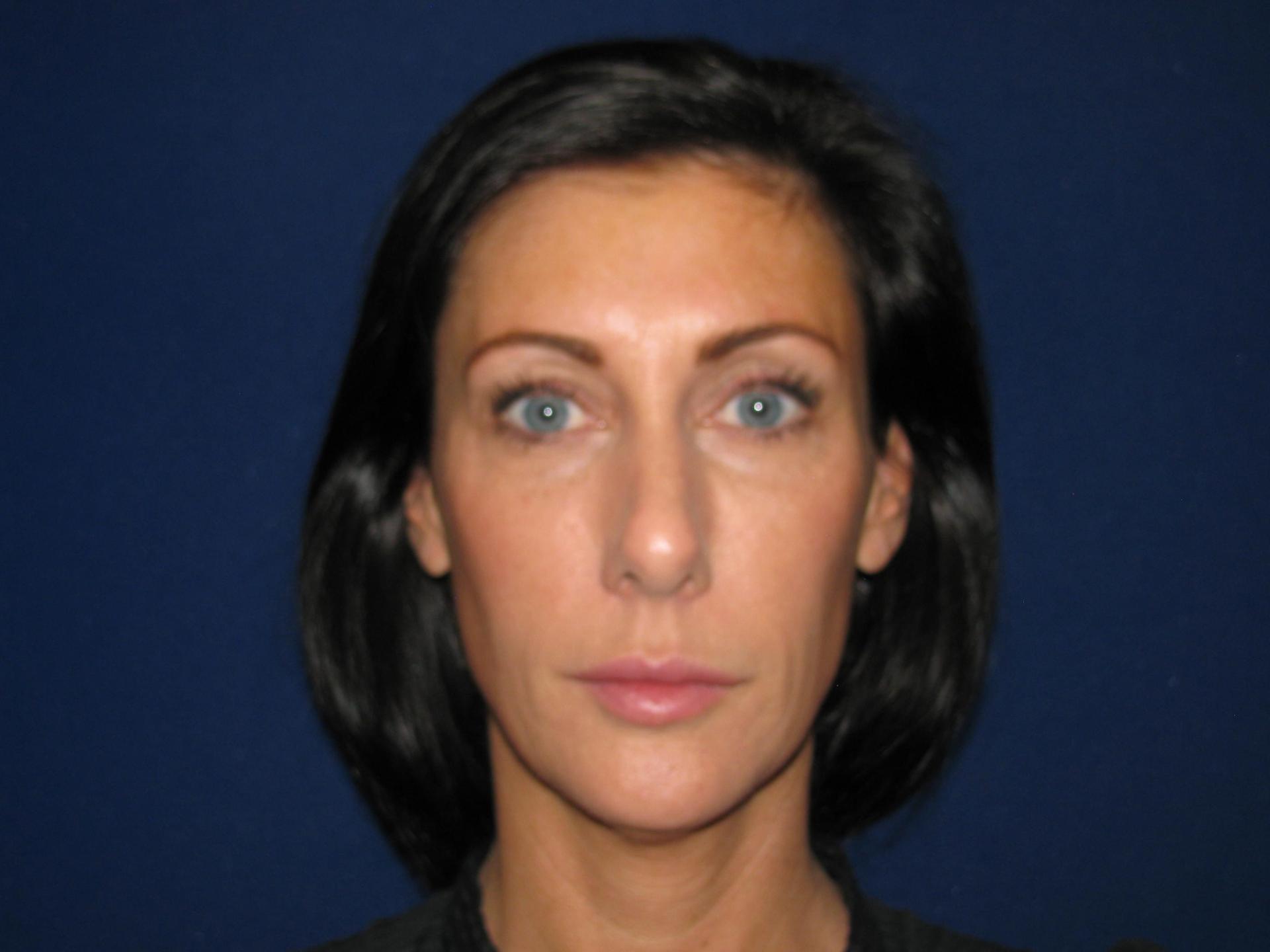 LV Plastic Surgery (Brian J. Parker, MD) rhinoplasty after — Las Vegas, NV