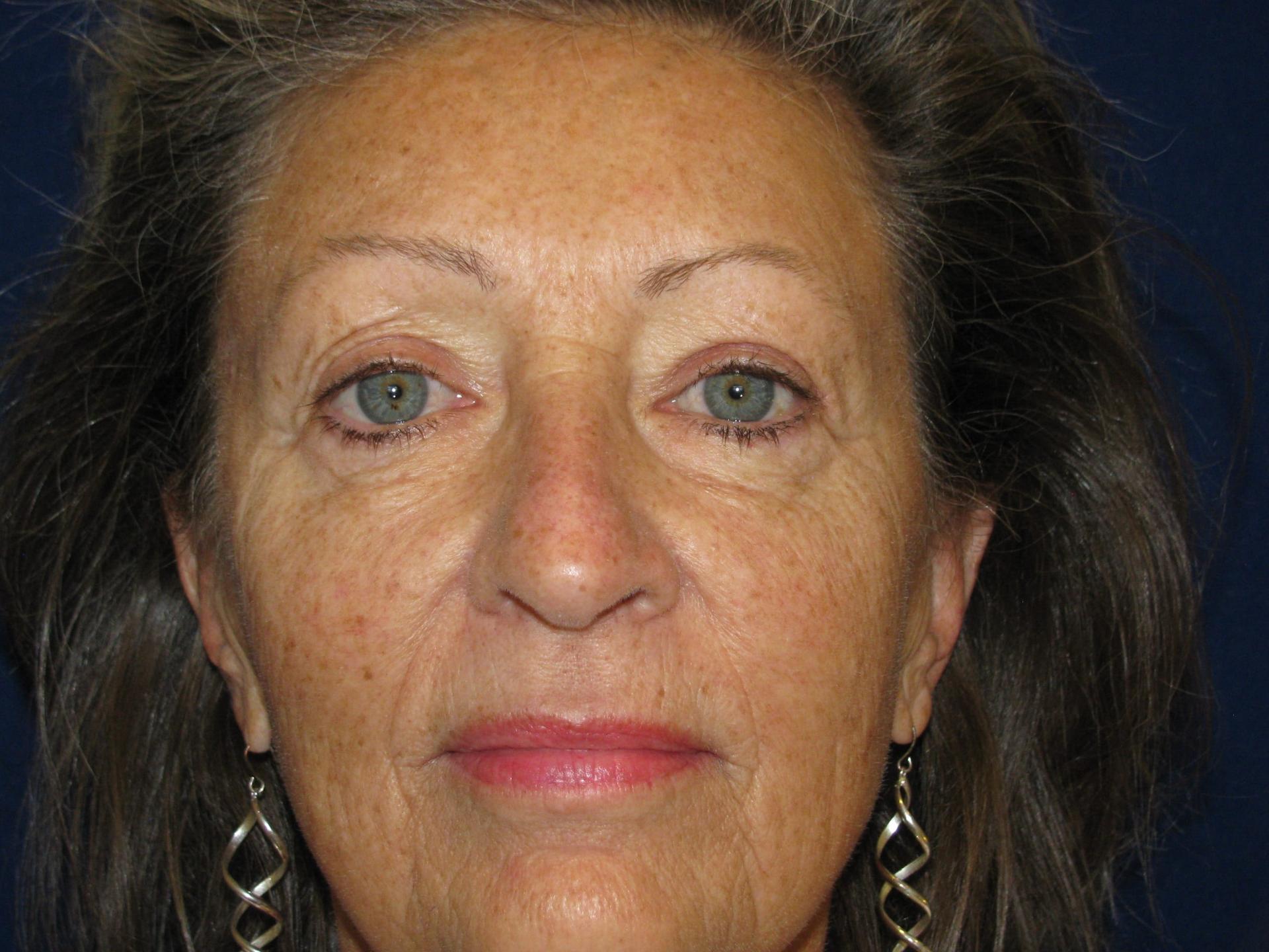 LV Plastic Surgery (Brian J. Parker, MD) eyelid lift after — Las Vegas, NV