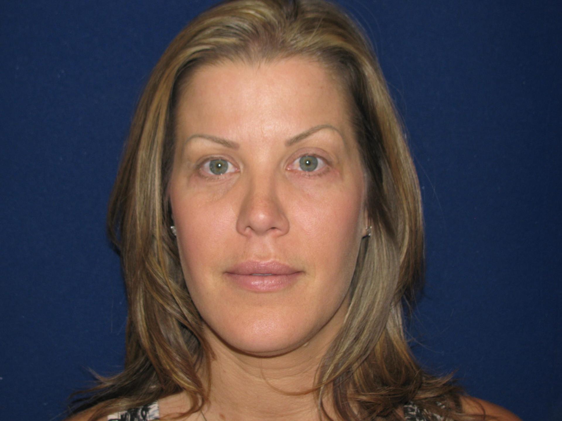 LV Plastic Surgery (Brian J. Parker, MD) eyelid lift after — Las Vegas, NV