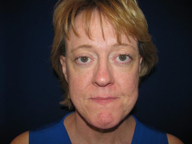 Facelift before at LV Plastic Surgery (Brian J. Parker, MD) in Las Vegas, NV