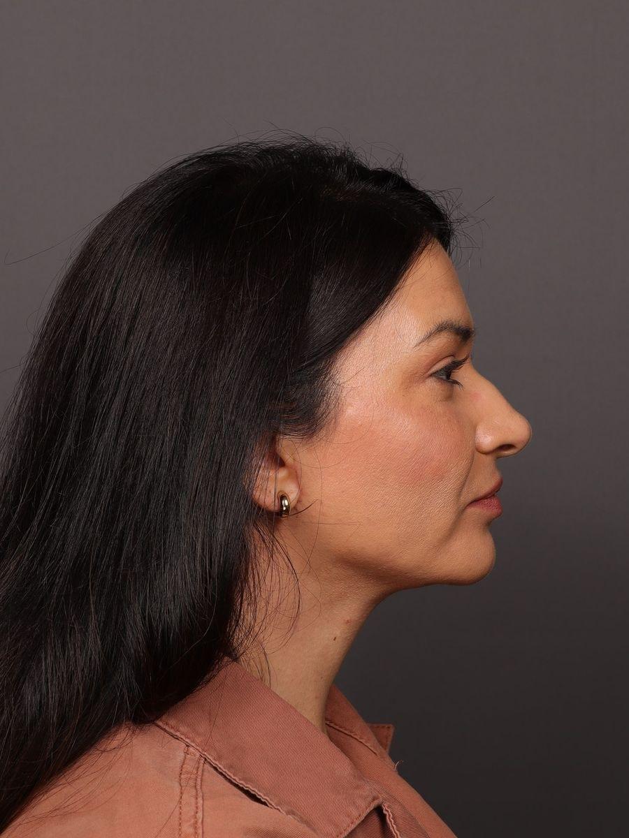 Manning Facial Plastic Surgery neck lift after — Bountiful, UT