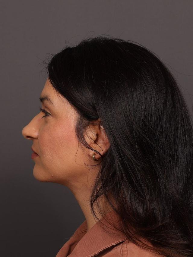 Neck Lift after at Manning Facial Plastic Surgery in Bountiful, UT