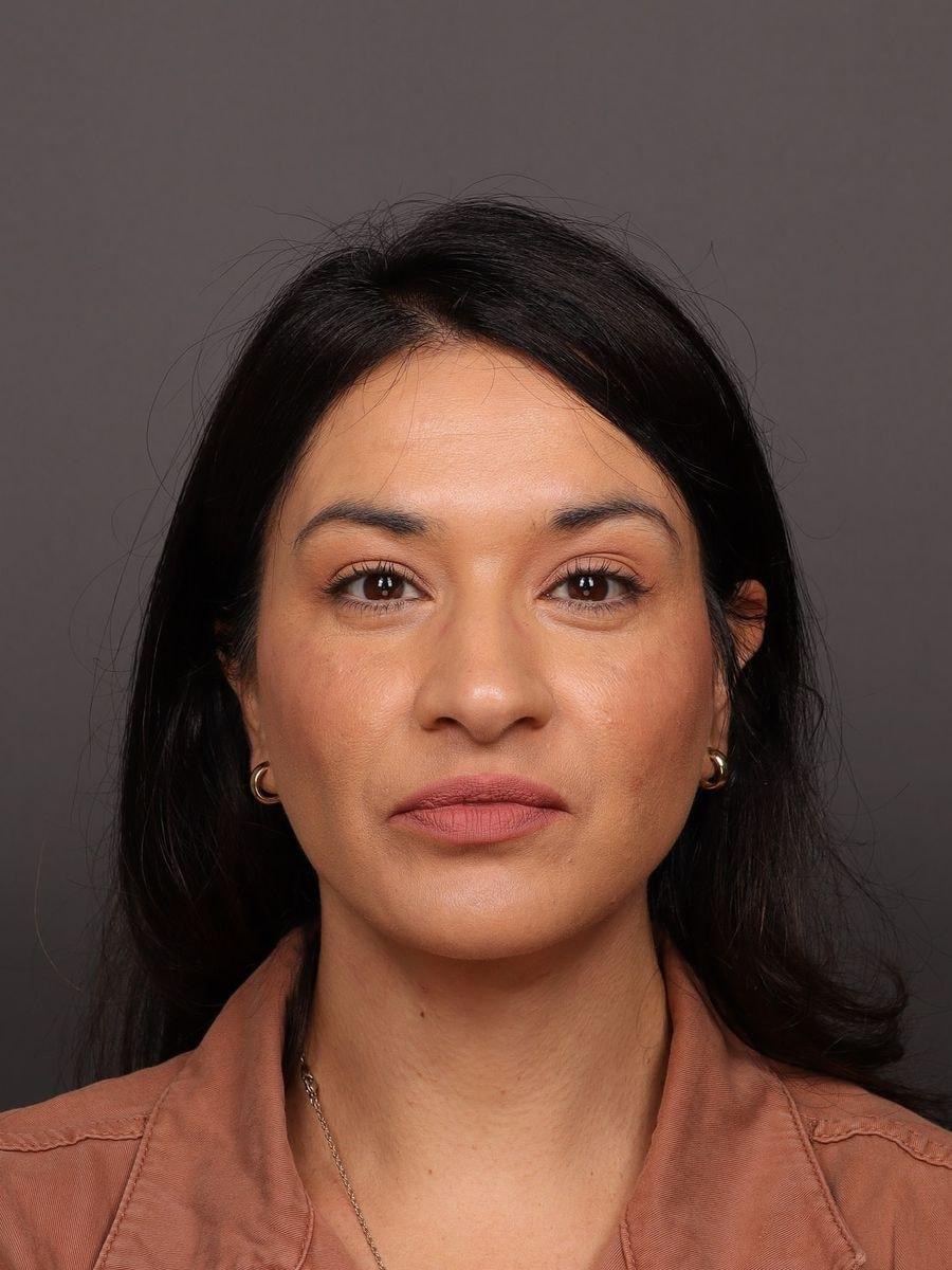 Manning Facial Plastic Surgery neck lift after — Bountiful, UT