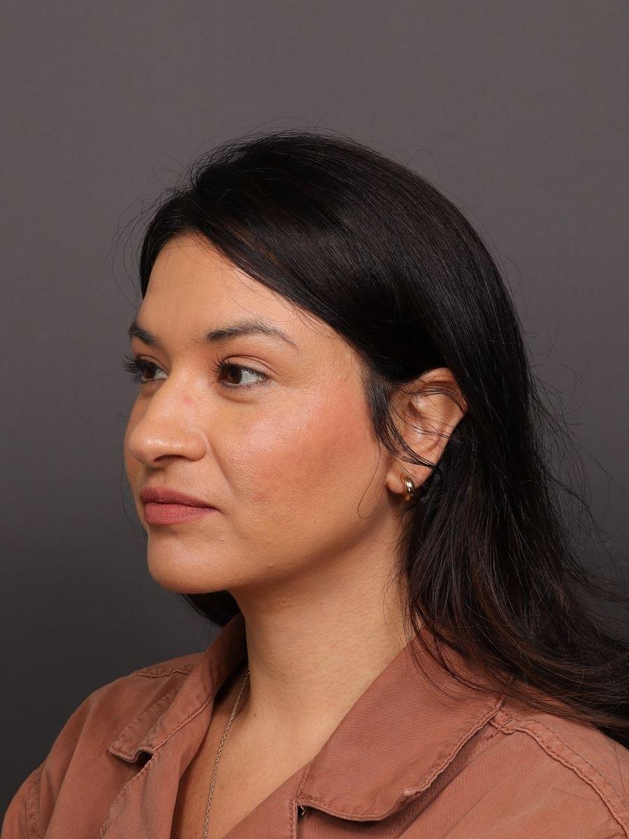 Manning Facial Plastic Surgery neck lift after — Bountiful, UT