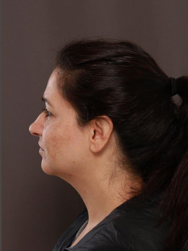 Neck Lift before at Manning Facial Plastic Surgery in Bountiful, UT