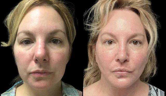 Brazilian Butt Lift result at Bitar Cosmetic Surgery Institute & Medspa in Fairfax, VA