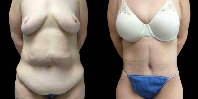CoolSculpting result at Bitar Cosmetic Surgery Institute & Medspa in Fairfax, VA