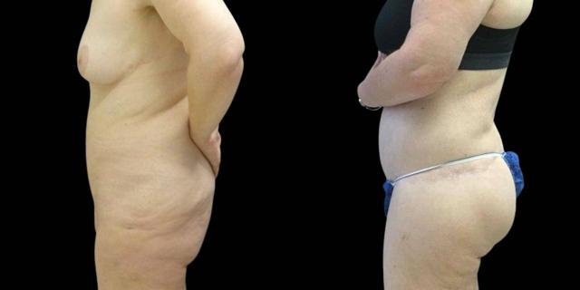 CoolSculpting result at Bitar Cosmetic Surgery Institute & Medspa in Fairfax, VA