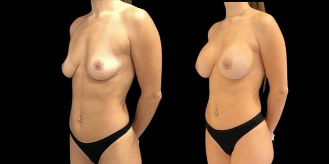 Breast Augmentation result at Bitar Cosmetic Surgery Institute & Medspa in Fairfax, VA