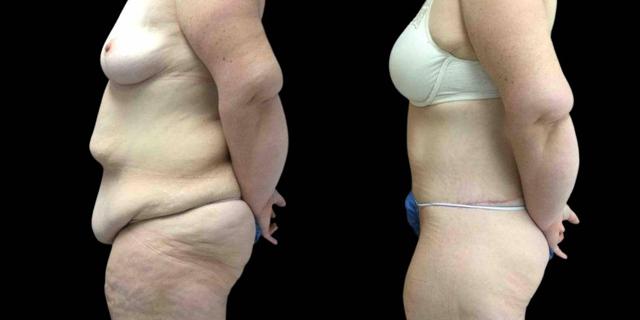 CoolSculpting result at Bitar Cosmetic Surgery Institute & Medspa in Fairfax, VA