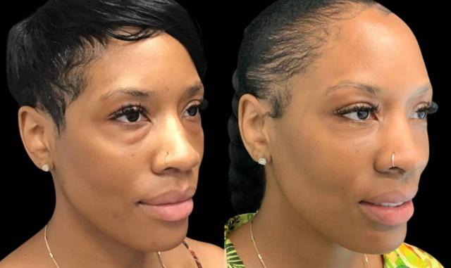 Blepharoplasty result at Bitar Cosmetic Surgery Institute & Medspa in Fairfax, VA