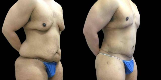 CoolSculpting result at Bitar Cosmetic Surgery Institute & Medspa in Fairfax, VA