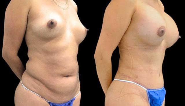Mommy Makeover result at Bitar Cosmetic Surgery Institute & Medspa in Fairfax, VA