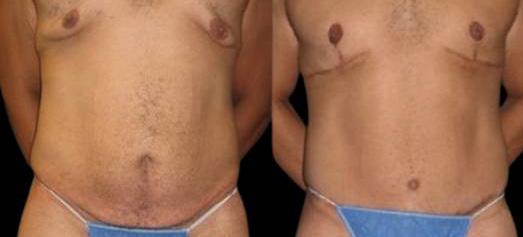 Gynecomastia Surgery result at Bitar Cosmetic Surgery Institute & Medspa in Fairfax, VA