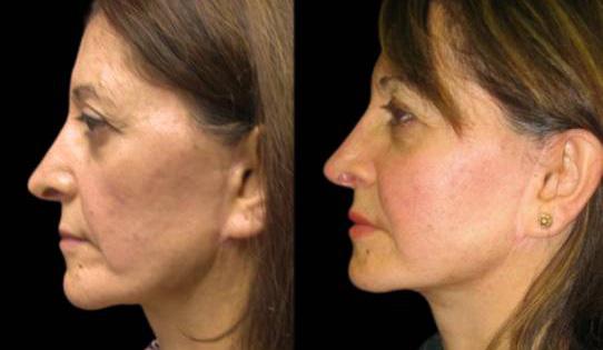 Facelift result at Bitar Cosmetic Surgery Institute & Medspa in Fairfax, VA