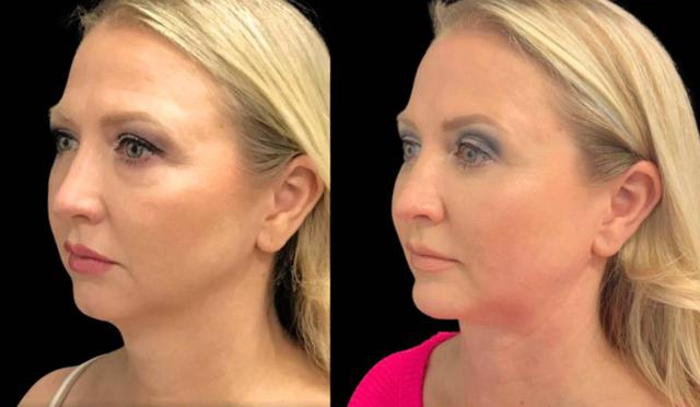Fat Transfer result at Bitar Cosmetic Surgery Institute & Medspa in Fairfax, VA
